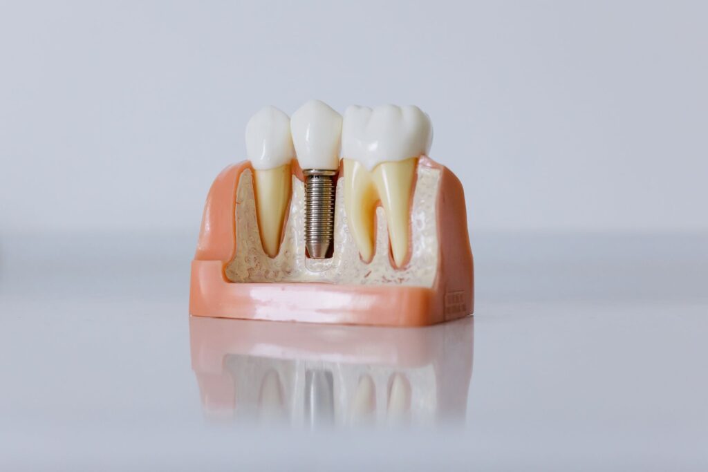 Close up 3D model of a dental implant